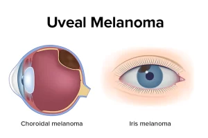 Choroidal Melanoma