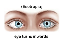 Esotropia - Inward turning