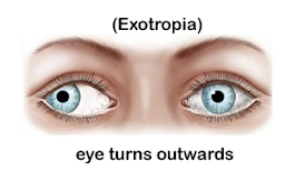 Exotropia - Outward turning