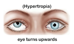 Hypotropia - Downward turning
