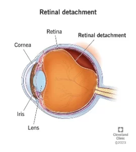 Retinal Detachment