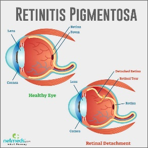 Retinitis Pigmentosa