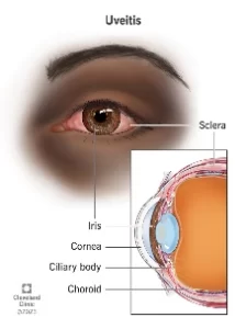Uveitis